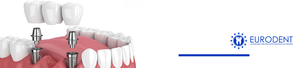 Zahnimplantat: Mehrere-fehlende-zahne