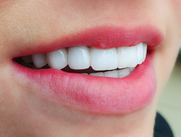 Zahnkorrektur - Warum Hollywood Smile?